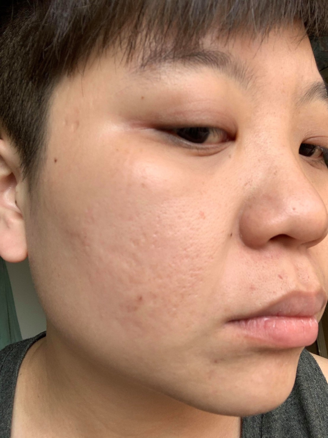 植萃煥新管理 痘痘後